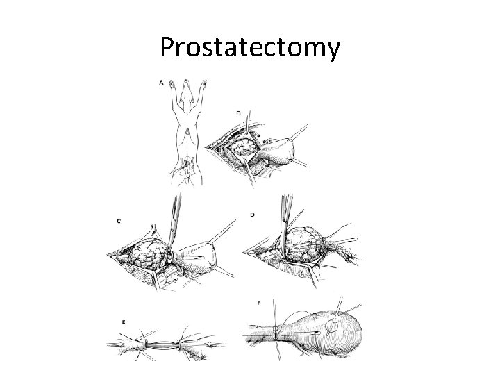 Prostatectomy 