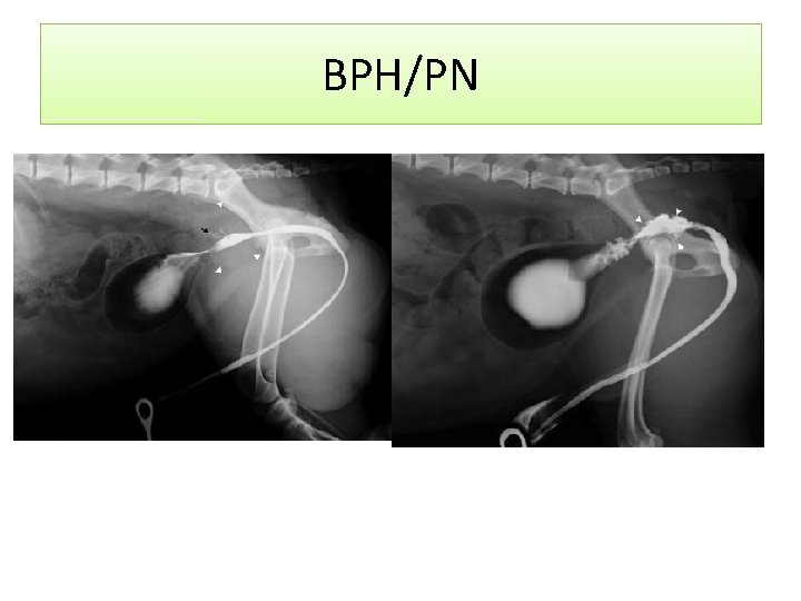 BPH/PN 