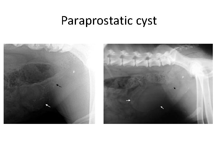 Paraprostatic cyst 