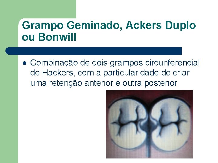 Grampo Geminado, Ackers Duplo ou Bonwill l Combinação de dois grampos circunferencial de Hackers,