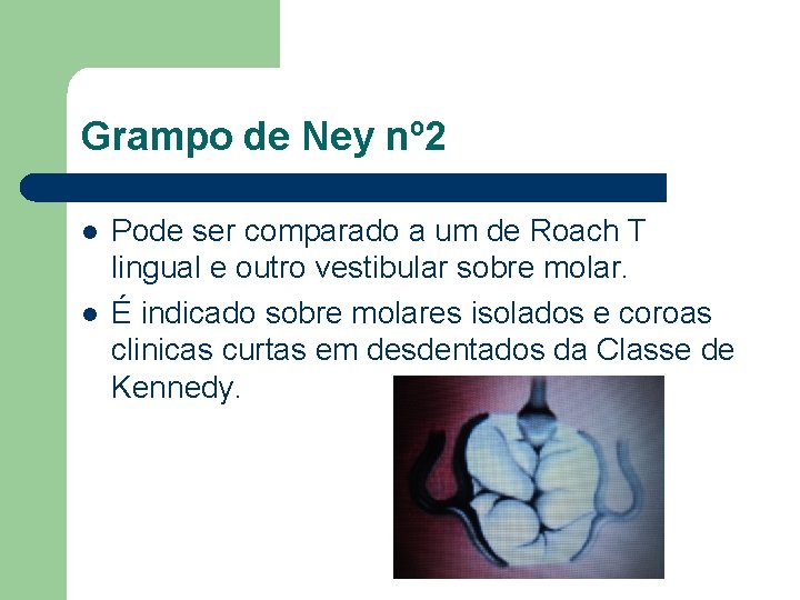 Grampo de Ney nº 2 l l Pode ser comparado a um de Roach