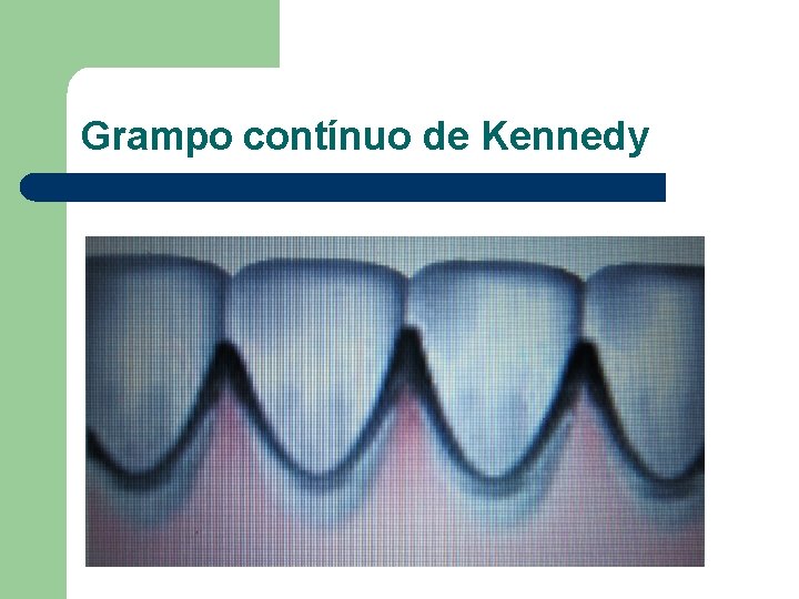 Grampo contínuo de Kennedy 