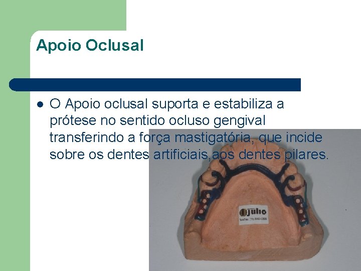 Apoio Oclusal l O Apoio oclusal suporta e estabiliza a prótese no sentido ocluso