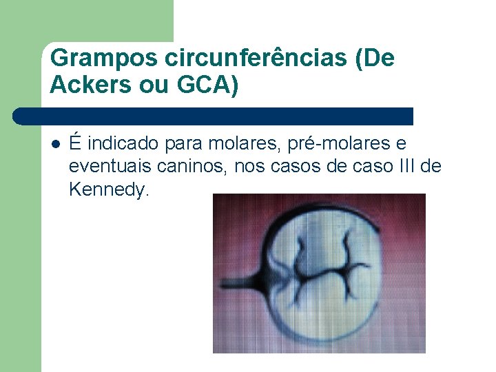 Grampos circunferências (De Ackers ou GCA) l É indicado para molares, pré-molares e eventuais