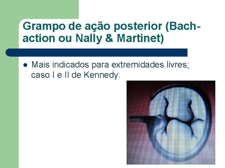 Grampo de ação posterior (Bachaction ou Nally & Martinet) l Mais indicados para extremidades