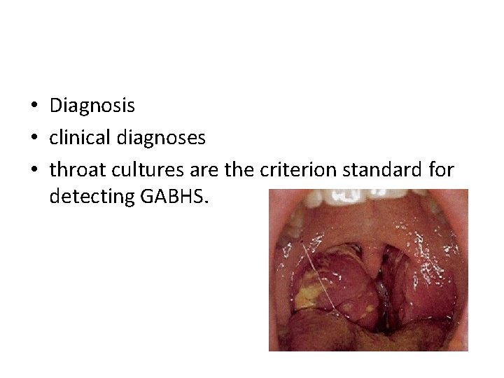  • Diagnosis • clinical diagnoses • throat cultures are the criterion standard for