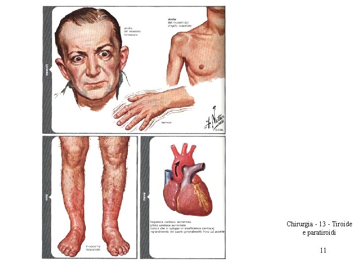 Chirurgia - 13 - Tiroide e paratiroidi 11 