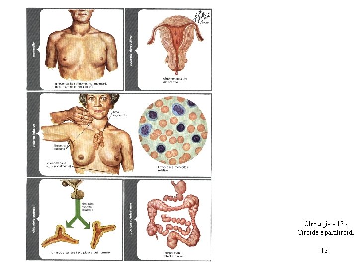 Chirurgia - 13 Tiroide e paratiroidi 12 