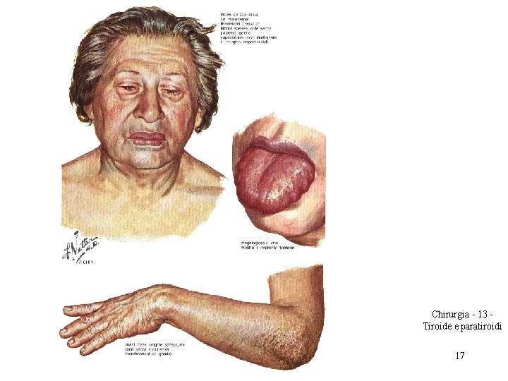 Chirurgia - 13 Tiroide e paratiroidi 17 