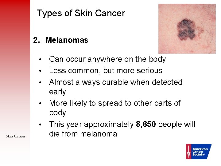 Types of Skin Cancer 2. Melanomas • • • Skin Cancer 11 Can occur