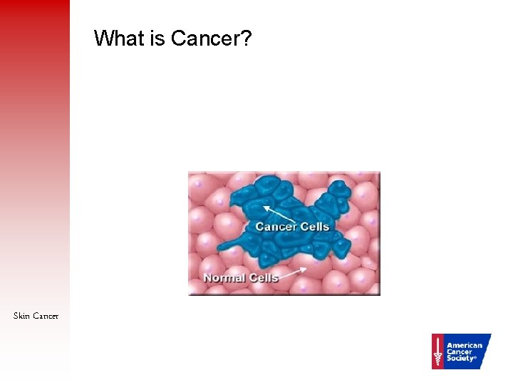 What is Cancer? Skin Cancer 2 