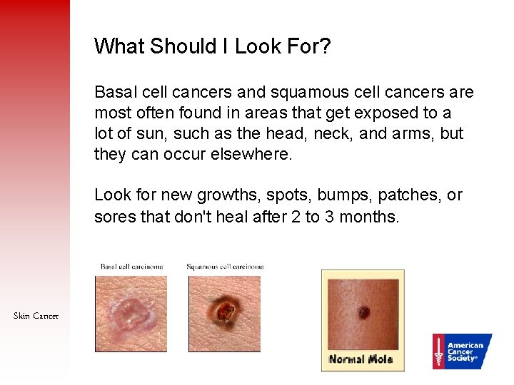 What Should I Look For? Basal cell cancers and squamous cell cancers are most