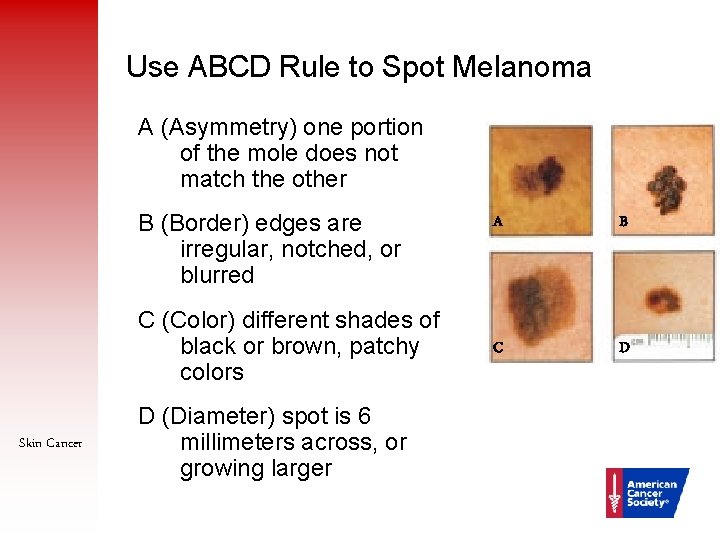 Use ABCD Rule to Spot Melanoma A (Asymmetry) one portion of the mole does