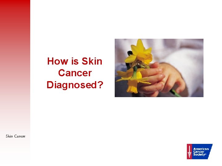 How is Skin Cancer Diagnosed? Skin Cancer 35 