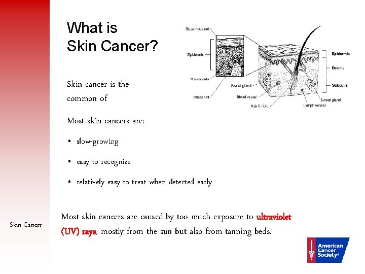 What is Skin Cancer? Skin cancer is the common of Most skin cancers are: