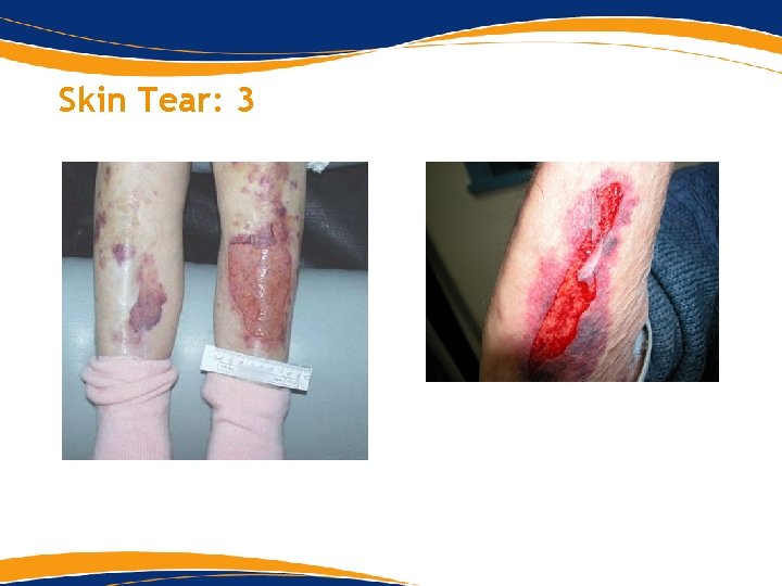 Skin Tear: 3 Skin Tear: 3