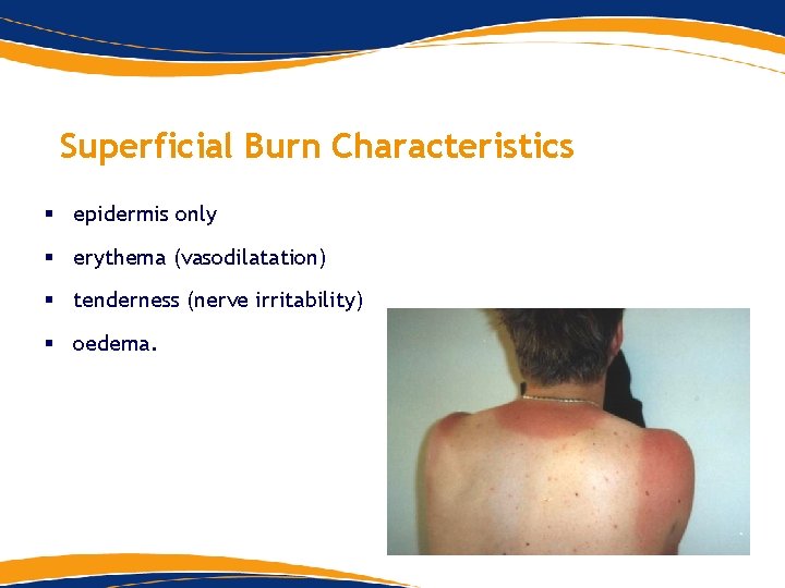 Superficial Burn Characteristics § epidermis only § erythema (vasodilatation) § tenderness (nerve irritability) § Superficial Burn Characteristics § epidermis only § erythema (vasodilatation) § tenderness (nerve irritability) §