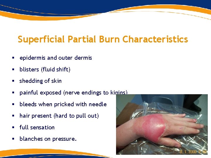 Superficial Partial Burn Characteristics § epidermis and outer dermis § blisters (fluid shift) § Superficial Partial Burn Characteristics § epidermis and outer dermis § blisters (fluid shift) §