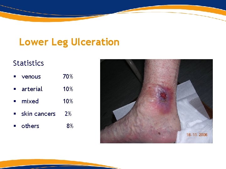Lower Leg Ulceration Statistics § venous 70% § arterial 10% § mixed 10% § Lower Leg Ulceration Statistics § venous 70% § arterial 10% § mixed 10% §