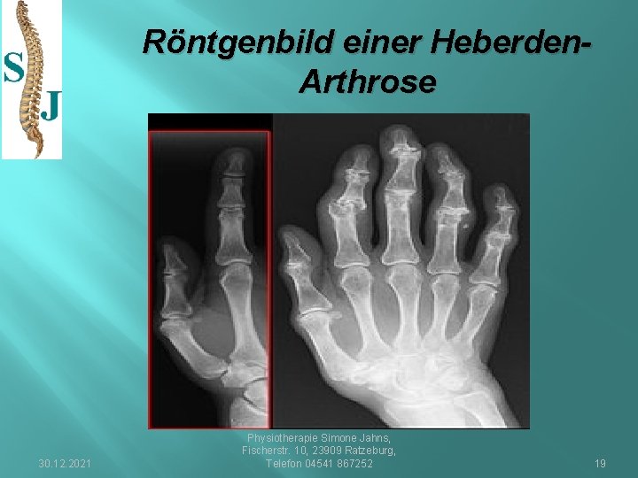 Röntgenbild einer Heberden. Arthrose 30. 12. 2021 Physiotherapie Simone Jahns, Fischerstr. 10, 23909 Ratzeburg,