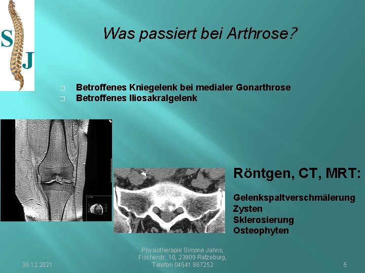 Was passiert bei Arthrose? � � Betroffenes Kniegelenk bei medialer Gonarthrose Betroffenes Iliosakralgelenk Röntgen,