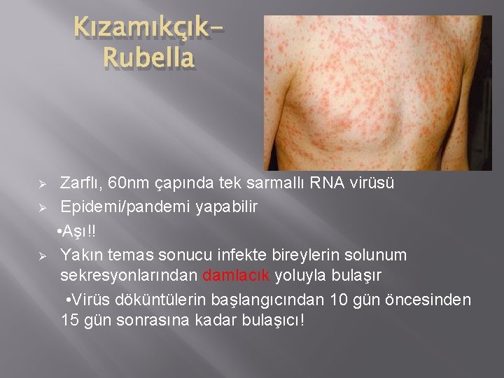Kızamıkçık. Rubella Ø Ø Ø Zarflı, 60 nm çapında tek sarmallı RNA virüsü Epidemi/pandemi
