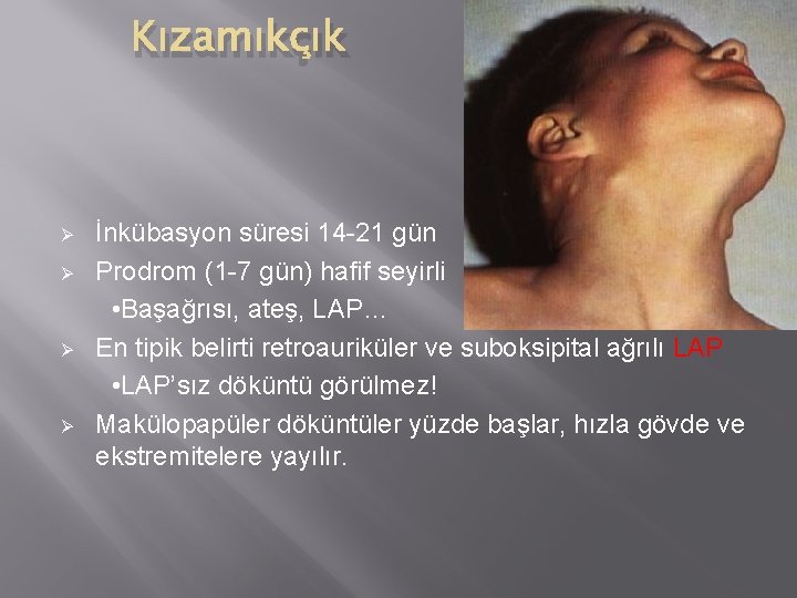 Kızamıkçık Ø Ø İnkübasyon süresi 14 -21 gün Prodrom (1 -7 gün) hafif seyirli