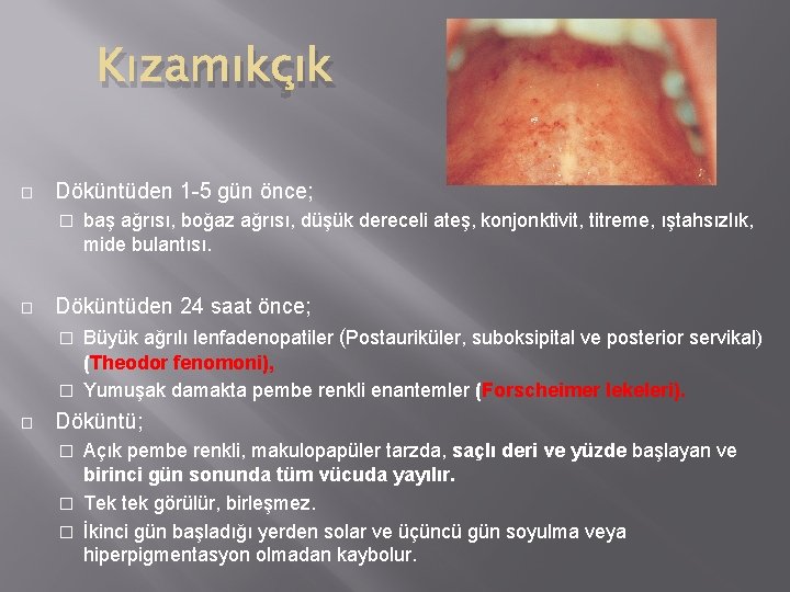 Kızamıkçık � Döküntüden 1 -5 gün önce; � � baş ağrısı, boğaz ağrısı, düşük