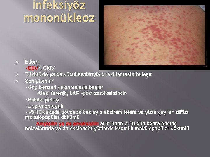 İnfeksiyöz mononükleoz Ø Ø Ø Etken • EBV*, CMV Tükürükle ya da vücut sıvılarıyla
