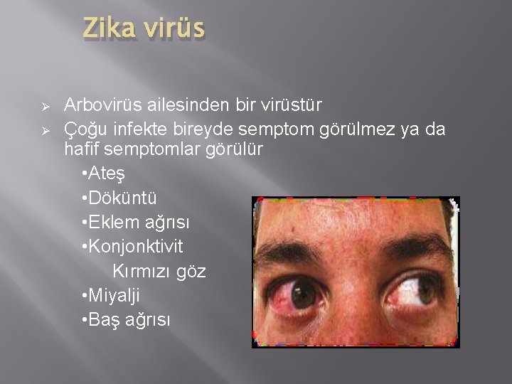 Zika virüs Ø Ø Arbovirüs ailesinden bir virüstür Çoğu infekte bireyde semptom görülmez ya