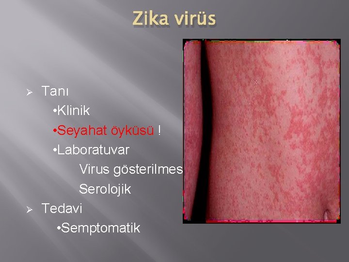 Zika virüs Ø Ø Tanı • Klinik • Seyahat öyküsü ! • Laboratuvar Virus