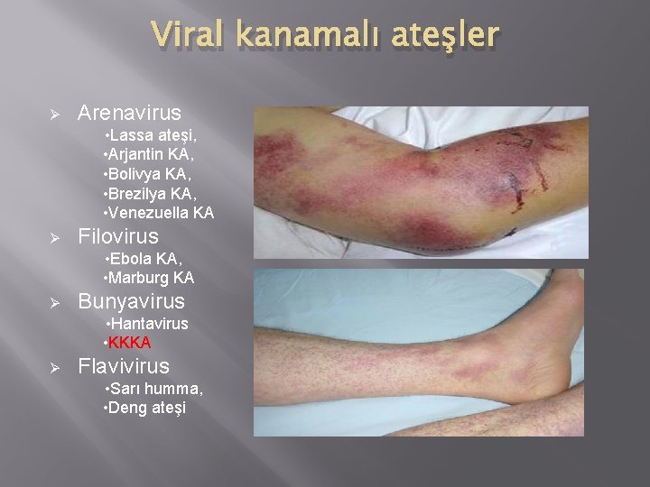 Viral kanamalı ateşler Ø Arenavirus • Lassa ateşi, • Arjantin KA, • Bolivya KA,