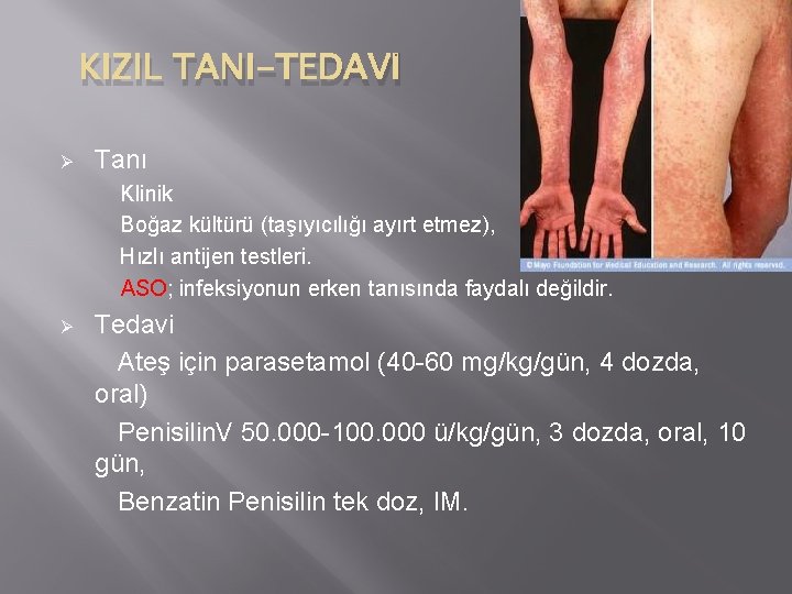 KIZIL TANI-TEDAVİ Ø Tanı Klinik Boğaz kültürü (taşıyıcılığı ayırt etmez), Hızlı antijen testleri. ASO;