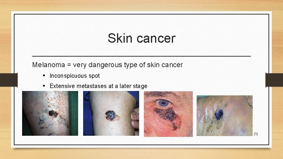 Skin cancer Melanoma = very dangerous type of skin cancer • Inconspicuous spot •