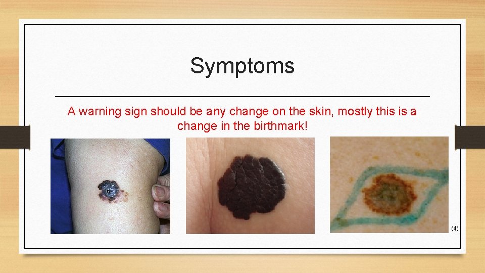 Symptoms A warning sign should be any change on the skin, mostly this is