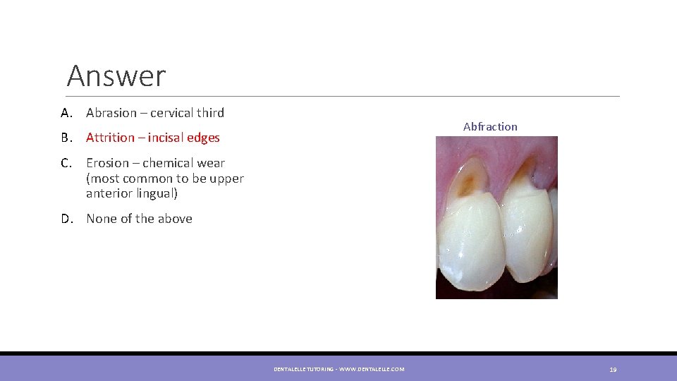 Answer A. Abrasion – cervical third Abfraction B. Attrition – incisal edges C. Erosion