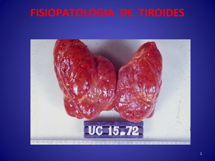 FISIOPATOLOGIA DE TIROIDES 1 