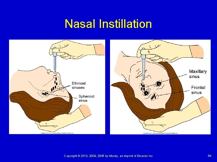 Nasal Instillation Copyright © 2013, 2009, 2005 by Mosby, an imprint of Elsevier Inc.