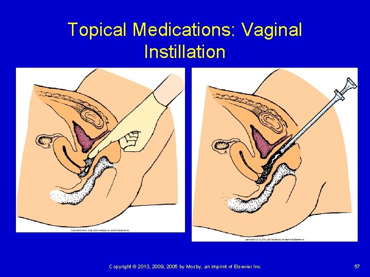 Topical Medications: Vaginal Instillation Copyright © 2013, 2009, 2005 by Mosby, an imprint of