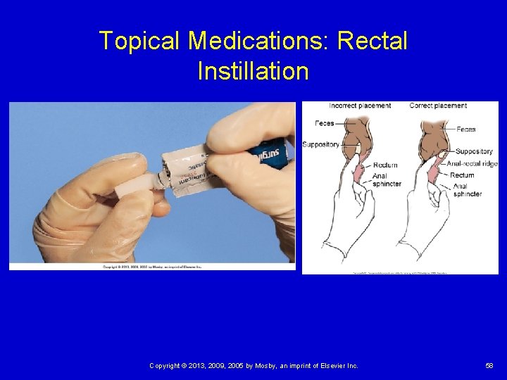 Topical Medications: Rectal Instillation Copyright © 2013, 2009, 2005 by Mosby, an imprint of