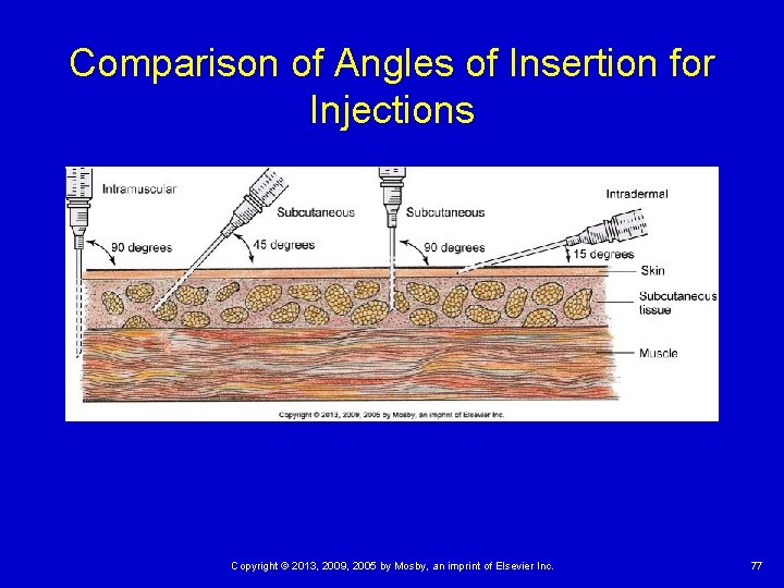 Comparison of Angles of Insertion for Injections Copyright © 2013, 2009, 2005 by Mosby,