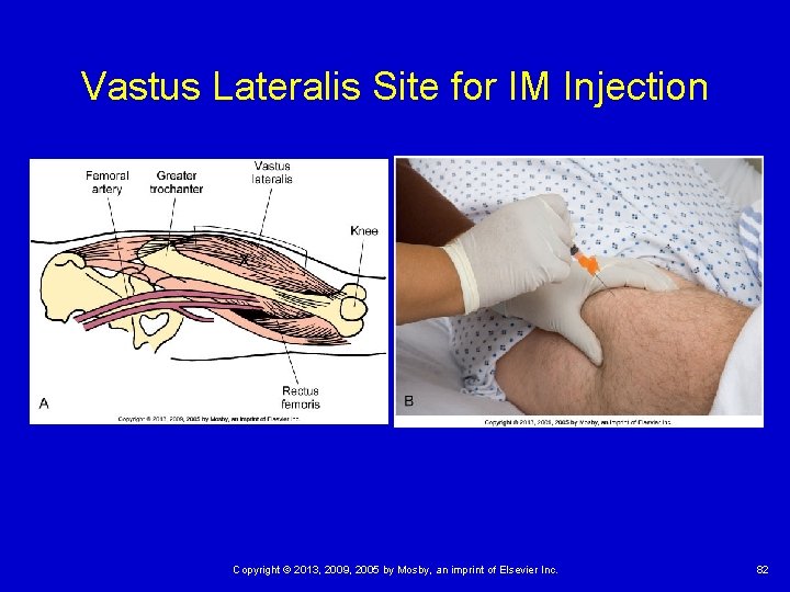 Vastus Lateralis Site for IM Injection Copyright © 2013, 2009, 2005 by Mosby, an