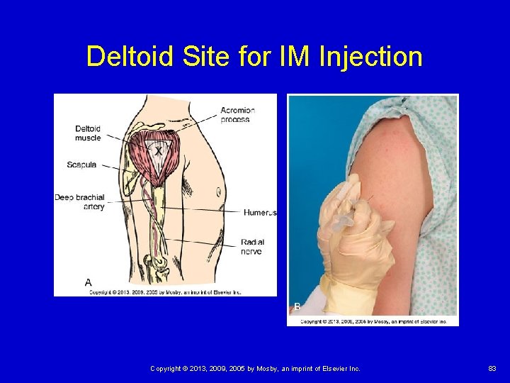 Deltoid Site for IM Injection Copyright © 2013, 2009, 2005 by Mosby, an imprint