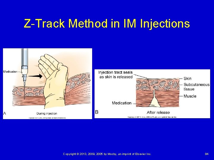 Z-Track Method in IM Injections Copyright © 2013, 2009, 2005 by Mosby, an imprint