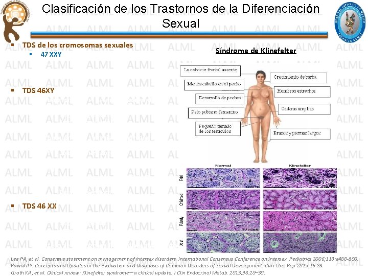 Clasificación de los Trastornos de la Diferenciación Sexual § TDS de los cromosomas sexuales Clasificación de los Trastornos de la Diferenciación Sexual § TDS de los cromosomas sexuales