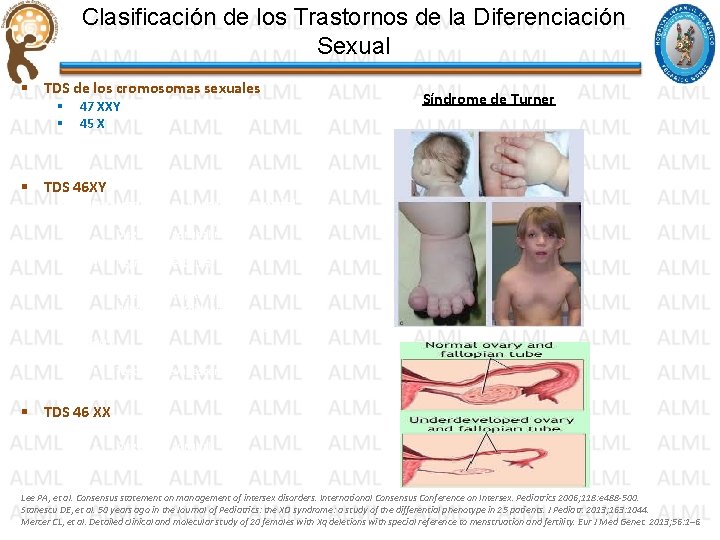 Clasificación de los Trastornos de la Diferenciación Sexual § TDS de los cromosomas sexuales Clasificación de los Trastornos de la Diferenciación Sexual § TDS de los cromosomas sexuales