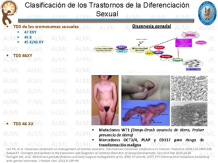 Clasificación de los Trastornos de la Diferenciación Sexual Disgenesia gonadal § TDS de los Clasificación de los Trastornos de la Diferenciación Sexual Disgenesia gonadal § TDS de los