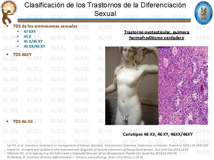 Clasificación de los Trastornos de la Diferenciación Sexual § TDS de los cromosomas sexuales Clasificación de los Trastornos de la Diferenciación Sexual § TDS de los cromosomas sexuales