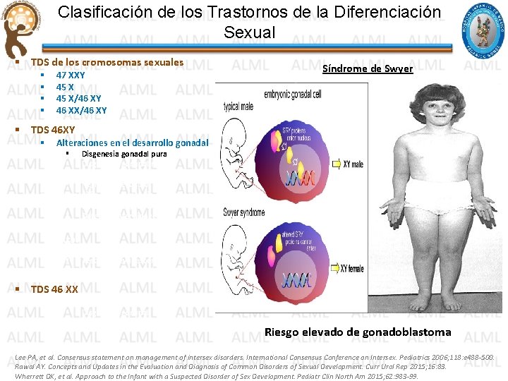 Clasificación de los Trastornos de la Diferenciación Sexual § TDS de los cromosomas sexuales Clasificación de los Trastornos de la Diferenciación Sexual § TDS de los cromosomas sexuales
