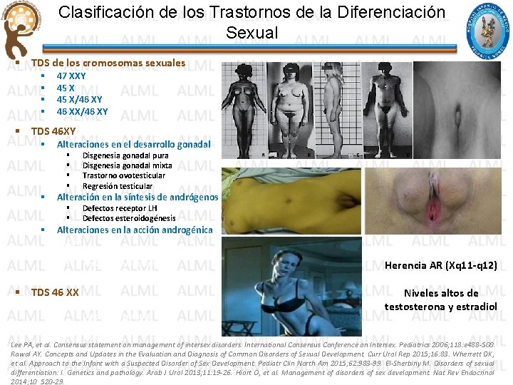 Clasificación de los Trastornos de la Diferenciación Sexual § TDS de los cromosomas sexuales Clasificación de los Trastornos de la Diferenciación Sexual § TDS de los cromosomas sexuales